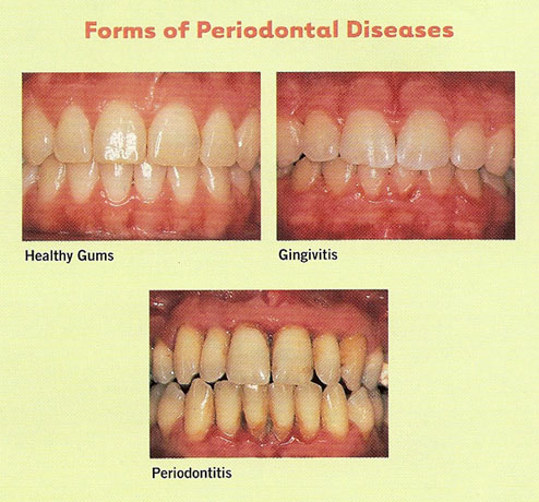 Periodontal Treatment - Danbe Dental, Dental office ...